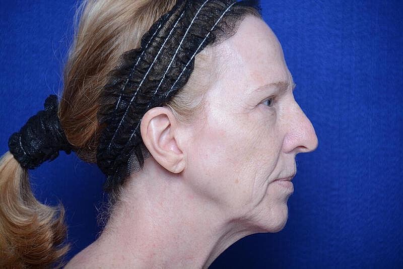 Lower Blepharoplasty Before & After