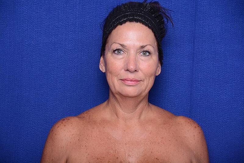 Lower Blepharoplasty Before & After
