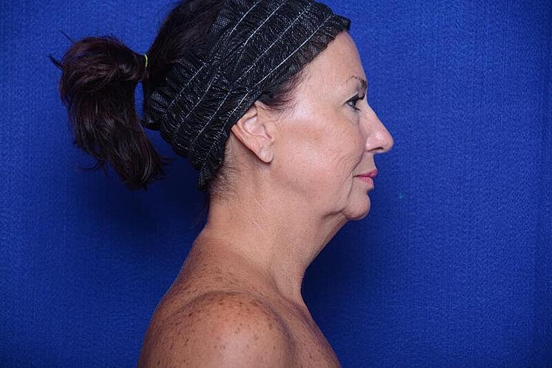 Lower Blepharoplasty Before & After