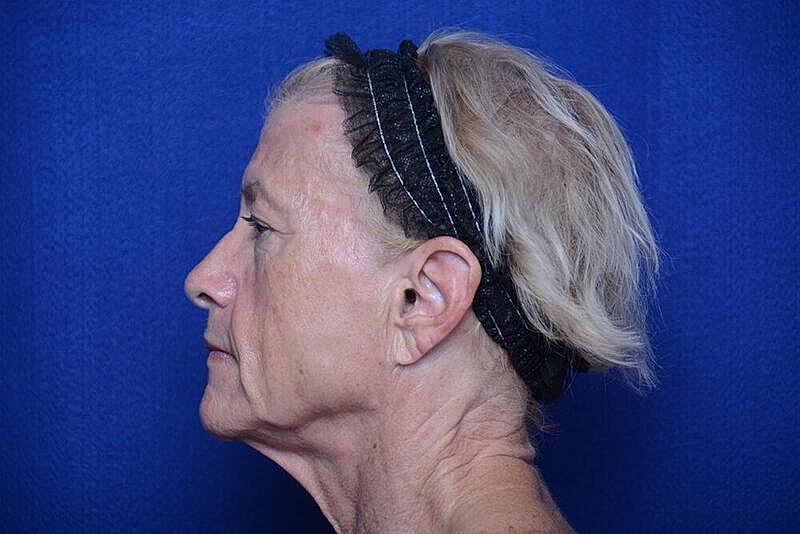 Lower Blepharoplasty Before & After