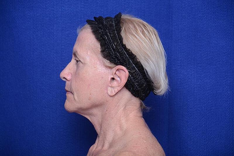 Lower Blepharoplasty Before & After