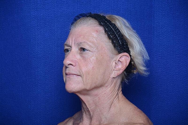 Lower Blepharoplasty Before & After