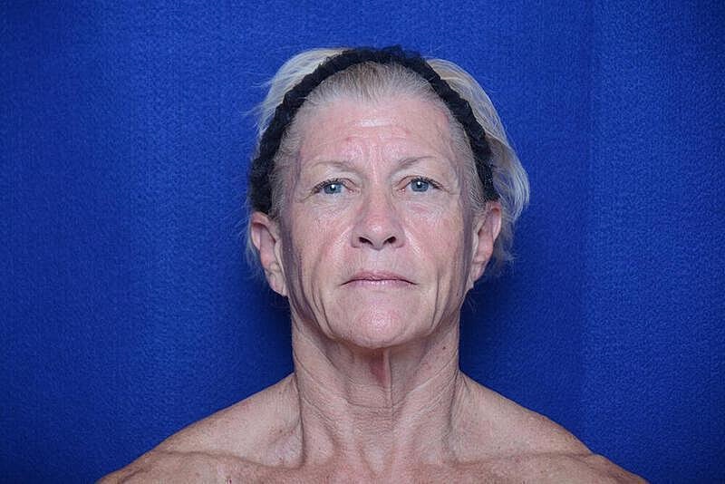 Lower Blepharoplasty Before & After