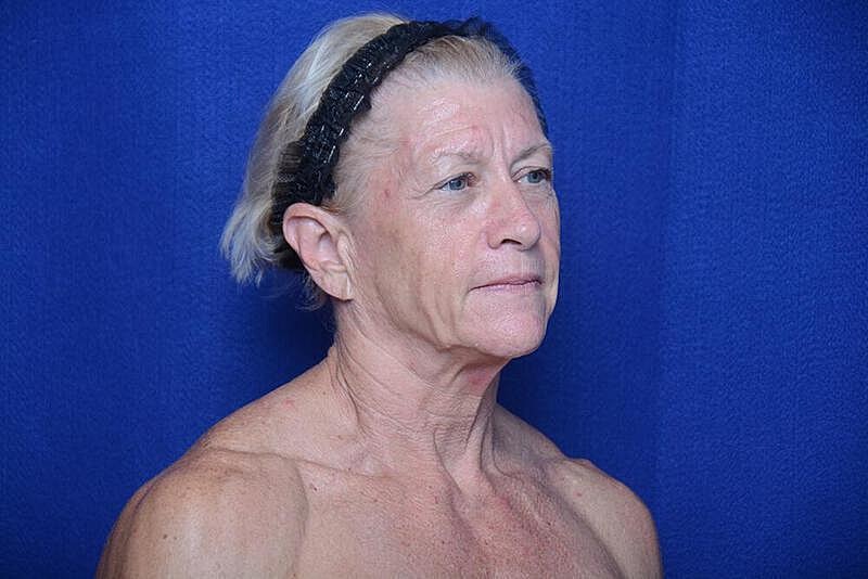 Lower Blepharoplasty Before & After