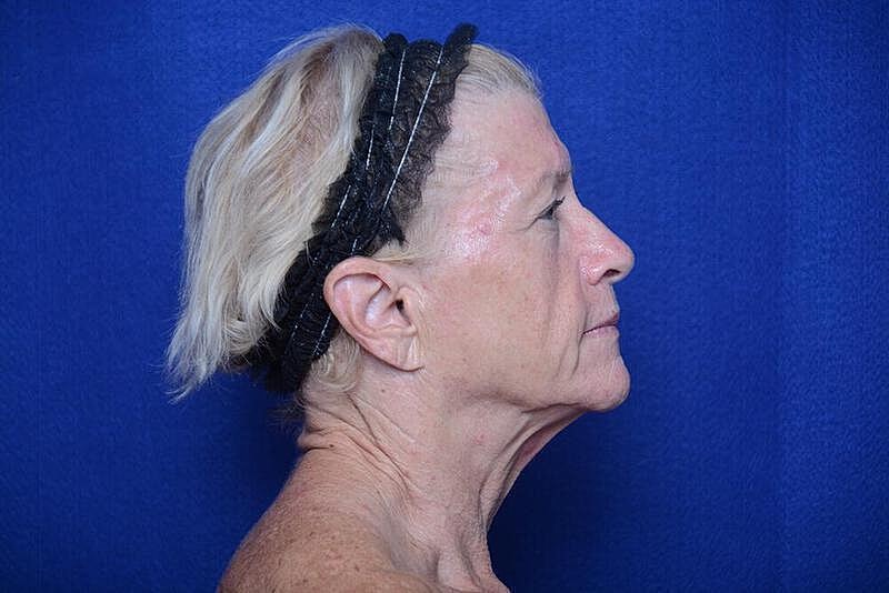 Lower Blepharoplasty Before & After