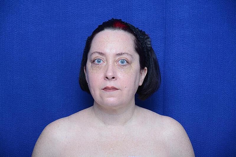 Lower Blepharoplasty Before & After