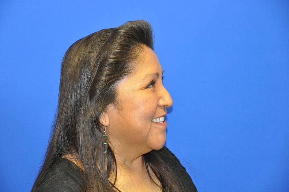 Lower Blepharoplasty Before & After