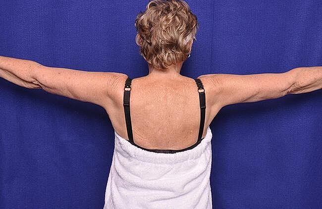 Arm Lift Before & After