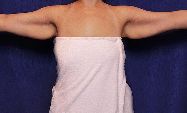 Arm Lift Before & After