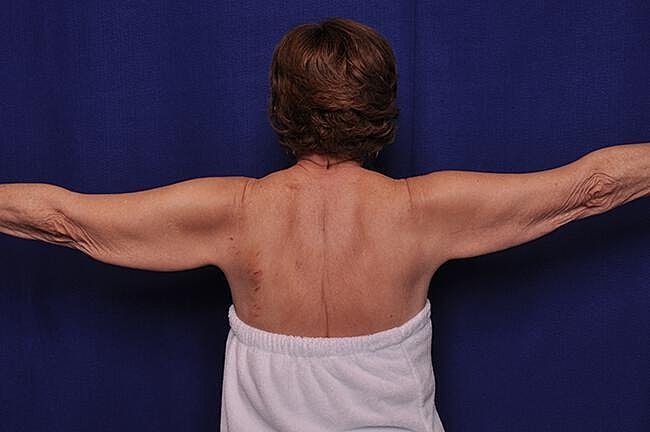 Arm Lift Before & After