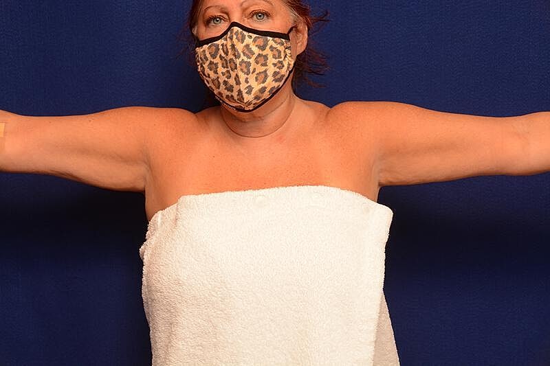 Arm Lift Before & After