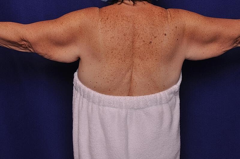 Arm Lift Before & After