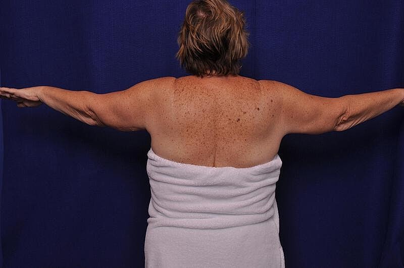 Arm Lift Before & After