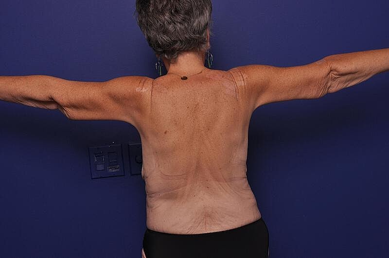 Arm Lift Before & After