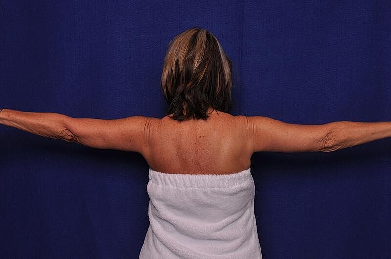 Arm Lift Before & After